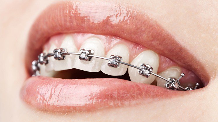 Ưu, nhược điểm của niềng răng mắc cài kim loại thường và tự buộc | Vinmec