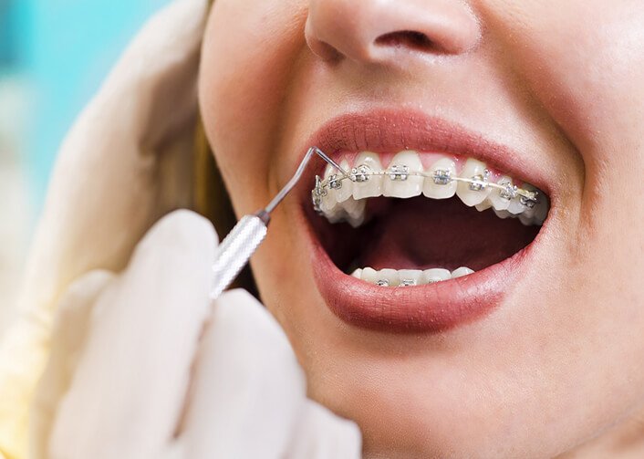 Niềng răng bao lâu mới hết đau? Niềng răng loại nào tốt nhất?