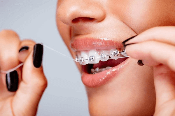 Nha Khoa Kim địa chỉ niềng răng chất lượng - lưu ý khi niềng răng
