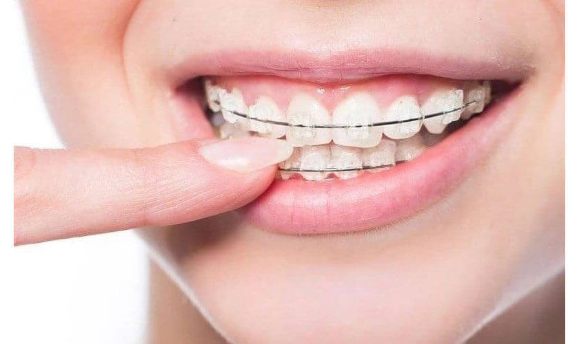 Quy trình niềng răng tại Nha khoa Platinum đúng chuẩn y khoa