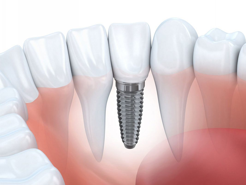 Cấy ghép Implant là phương pháp nha khoa thay thế răng thật tối ưu nhất hiện nay